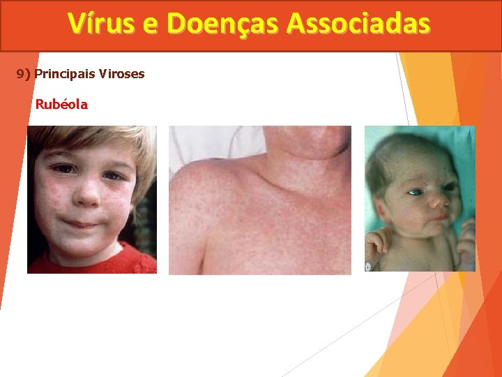 Vírus e Doenças Associadas 9) Principais Viroses Rubéola 