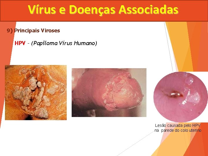 Vírus e Doenças Associadas 9) Principais Viroses HPV – (Papiloma Vírus Humano) Lesão causada