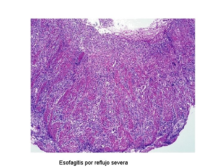 Esofagitis por reflujo severa 