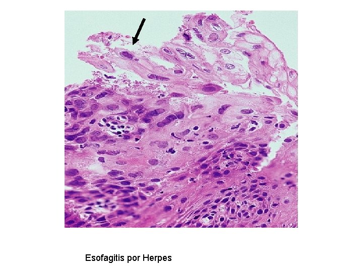 Esofagitis por Herpes 