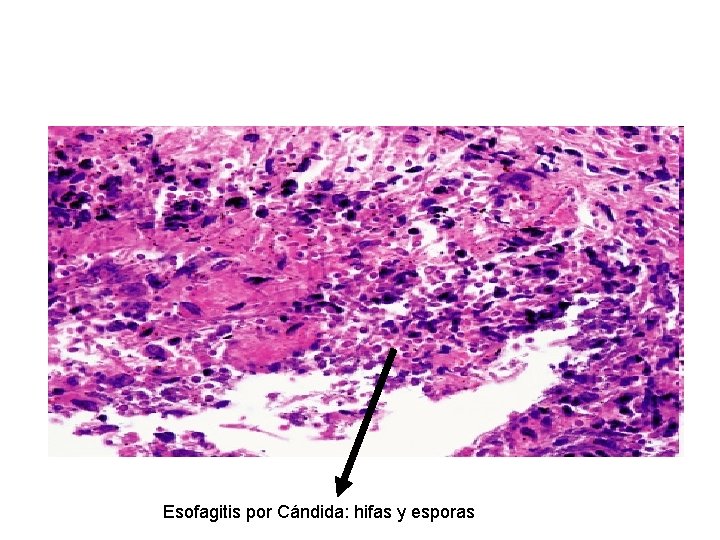 Esofagitis por Cándida: hifas y esporas 