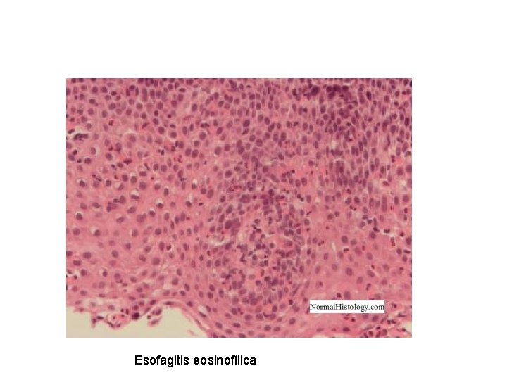 Esofagitis eosinofílica 
