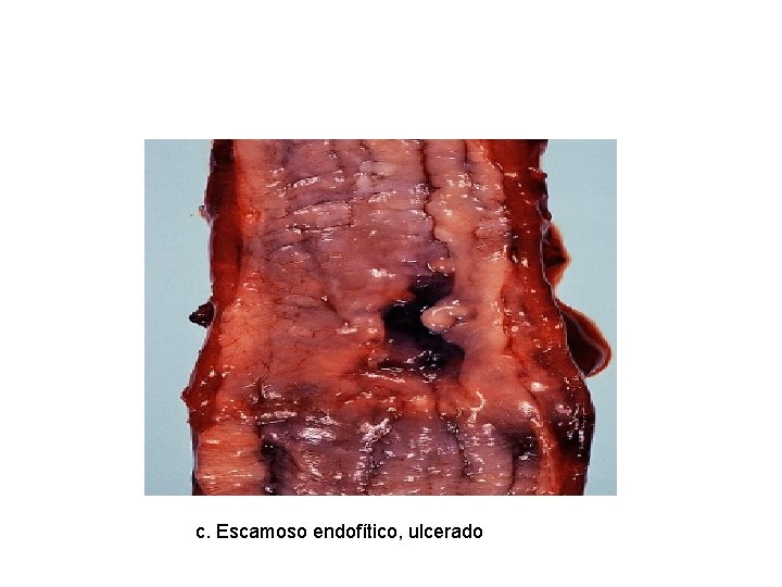 c. Escamoso endofítico, ulcerado 