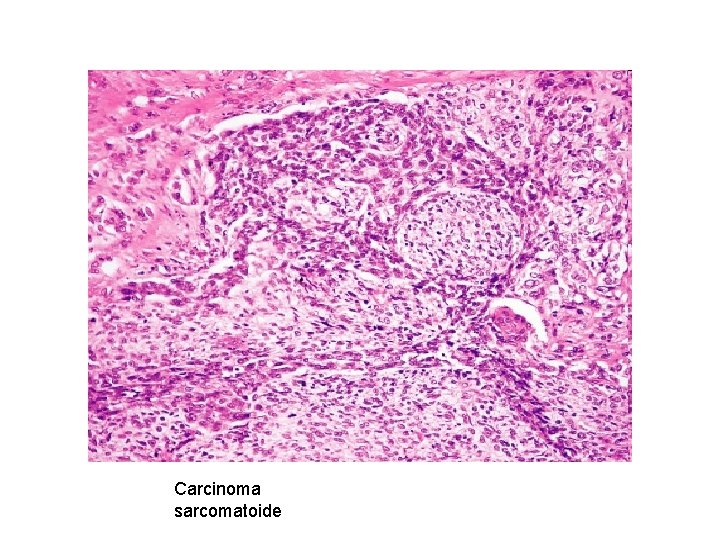 Carcinoma sarcomatoide 