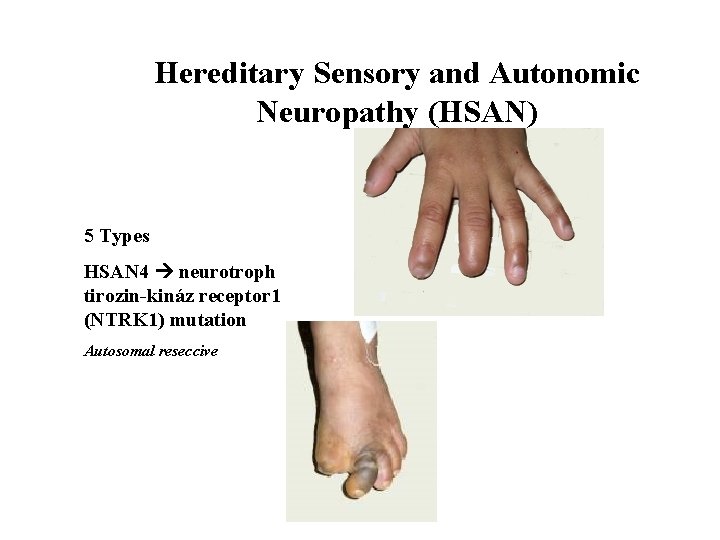 Hereditary Sensory and Autonomic Neuropathy (HSAN) 5 Types HSAN 4 neurotroph tirozin-kináz receptor 1
