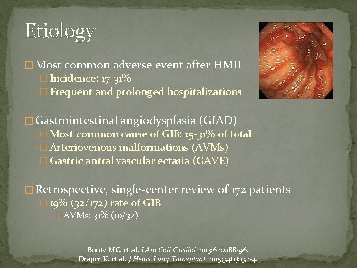 Etiology � Most common adverse event after HMII � Incidence: 17 -31% � Frequent