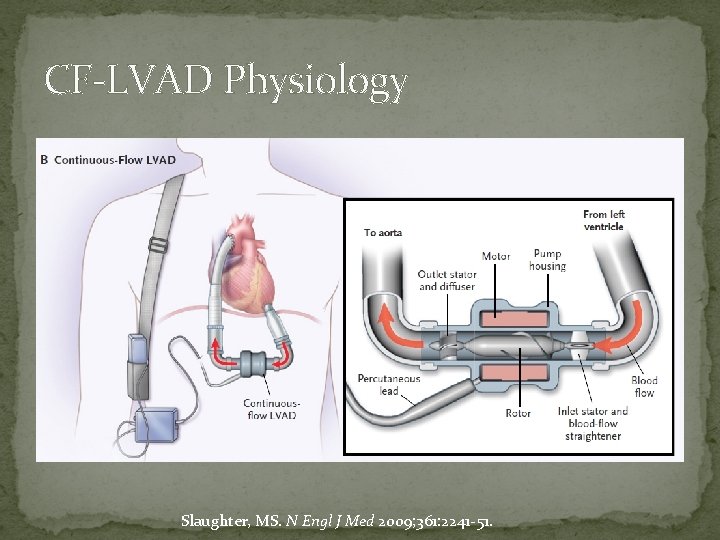 CF-LVAD Physiology Slaughter, MS. N Engl J Med 2009; 361: 2241 -51. 