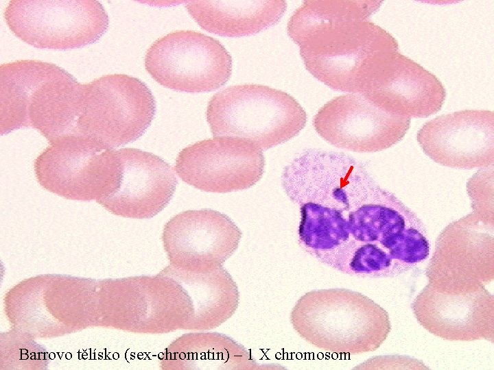 Barrovo tělísko (sex-chromatin) – 1 X chromosom 