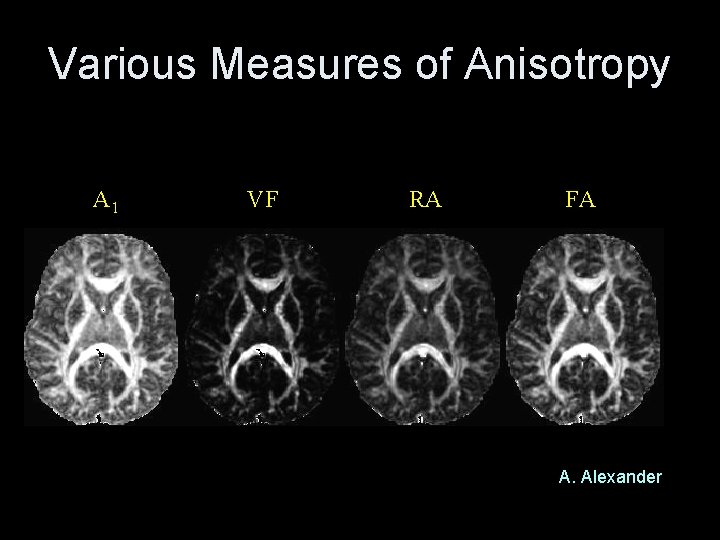 Various Measures of Anisotropy A 1 VF RA FA A. Alexander 