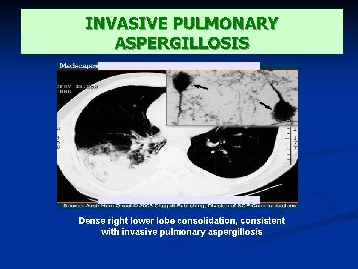 INVASIVE PULMONARY ASPERGILLOSIS Dense right lower lobe consolidation, consistent with invasive pulmonary aspergillosis 