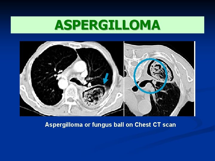 ASPERGILLOMA Aspergilloma or fungus ball on Chest CT scan 
