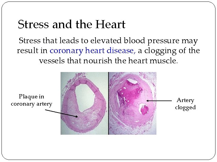 Stress and the Heart Stress that leads to elevated blood pressure may result in