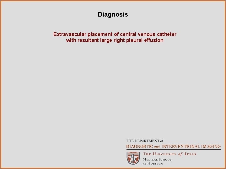 Diagnosis Extravascular placement of central venous catheter with resultant large right pleural effusion 