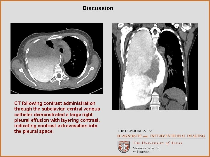 Discussion CT following contrast administration through the subclavian central venous catheter demonstrated a large