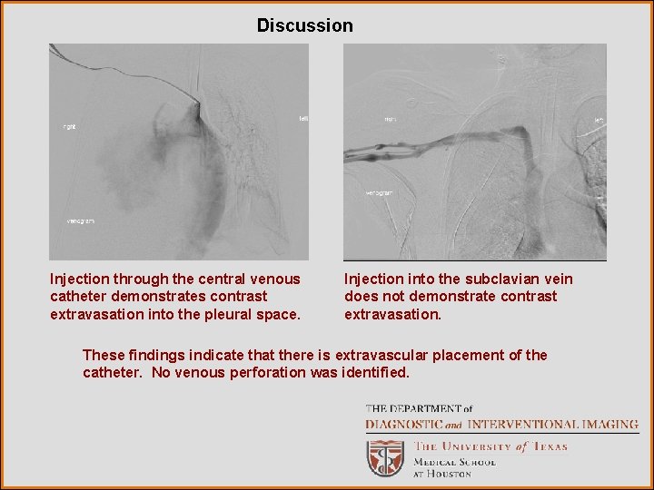 Discussion Injection through the central venous catheter demonstrates contrast extravasation into the pleural space.