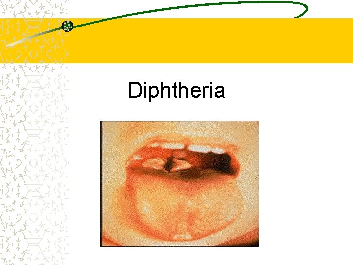 Diphtheria Epidemiology and Prevention of Vaccine. Preventable Diseases National Immunization Program Centers for Disease