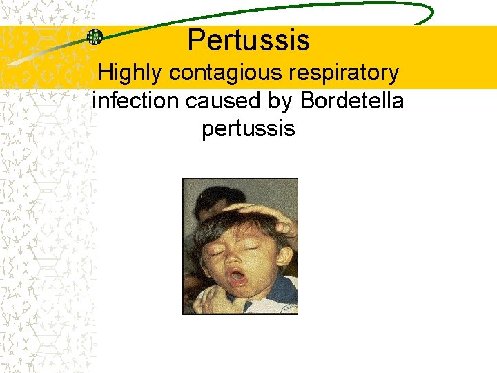 Pertussis Highly contagious respiratory infection caused by Bordetella pertussis Epidemiology and Prevention of Vaccine.