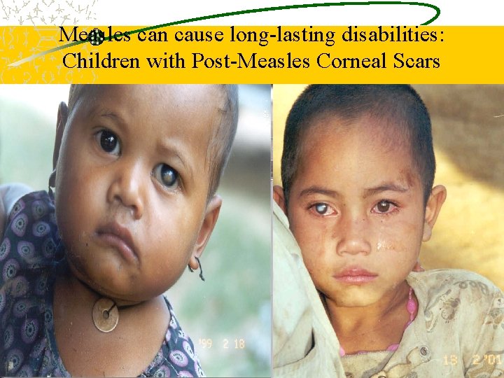 Measles can cause long-lasting disabilities: Children with Post-Measles Corneal Scars 