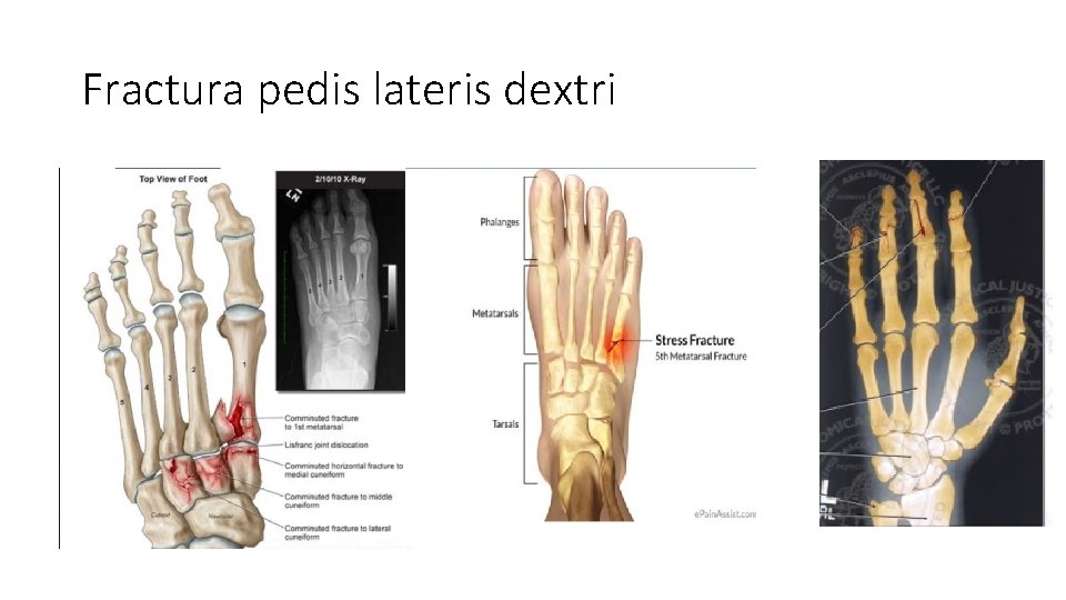 Fractura pedis lateris dextri 