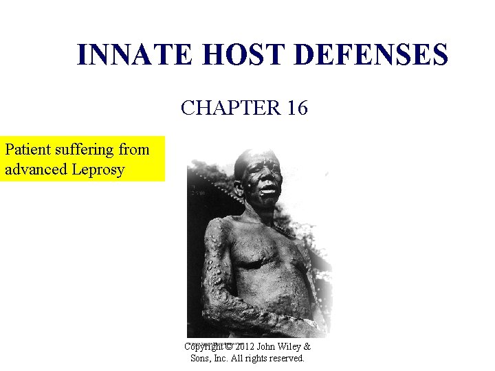 INNATE HOST DEFENSES CHAPTER 16 Patient suffering from advanced Leprosy Copyright © 2012 John