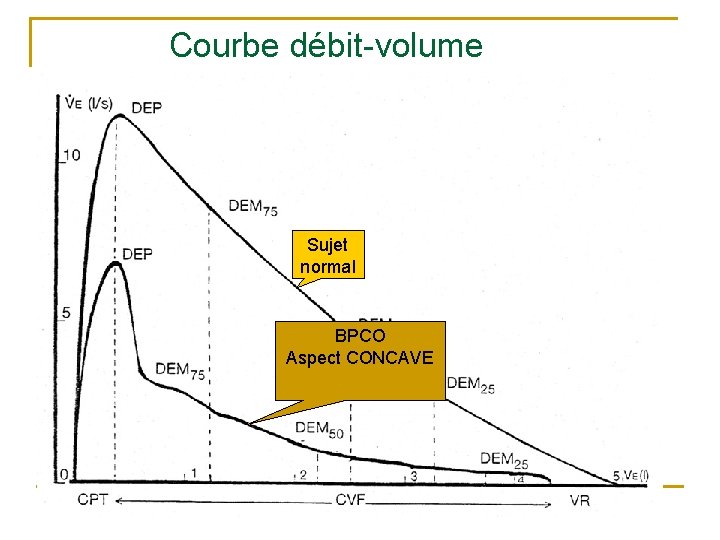 Courbe débit-volume Sujet normal BPCO Aspect CONCAVE 