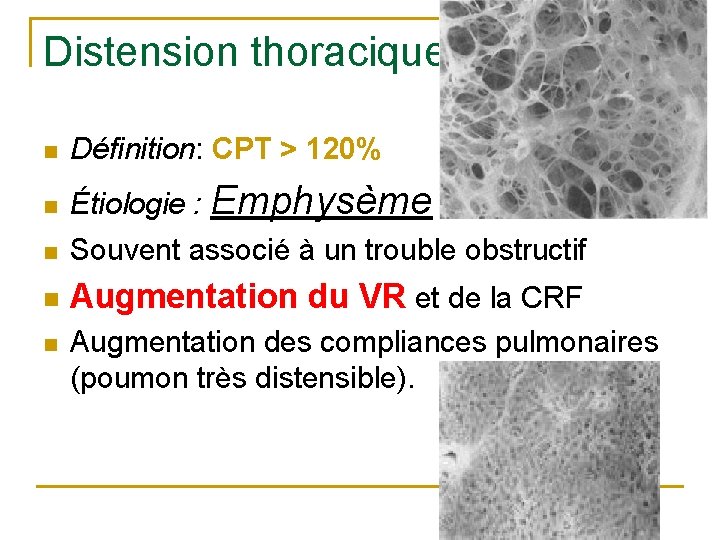 Distension thoracique n Définition: CPT > 120% n Étiologie : Emphysème n Souvent associé