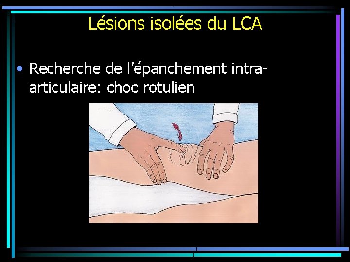 Lésions isolées du LCA • Recherche de l’épanchement intraarticulaire: choc rotulien 