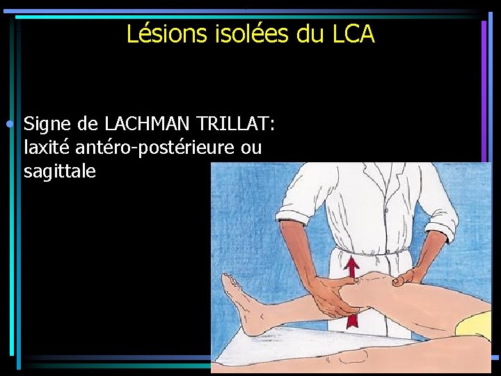 Lésions isolées du LCA • Signe de LACHMAN TRILLAT: laxité antéro-postérieure ou sagittale 