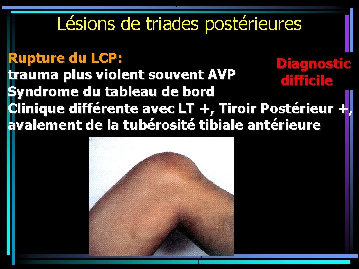 Lésions de triades postérieures Rupture du LCP: Diagnostic trauma plus violent souvent AVP difficile