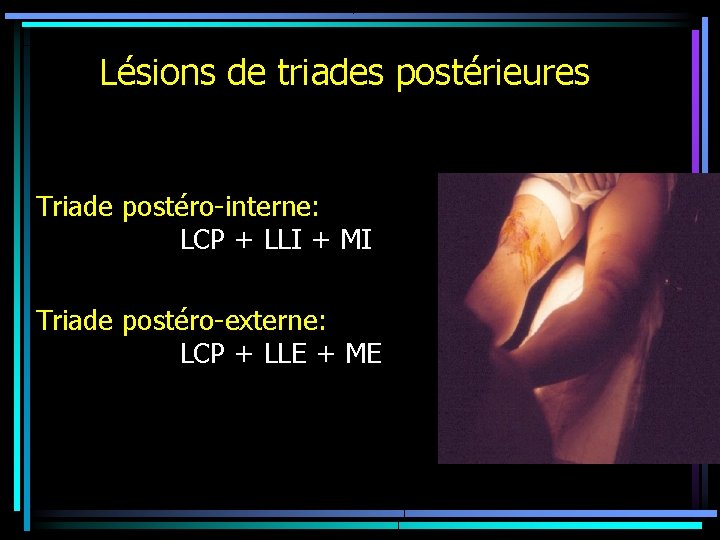 Lésions de triades postérieures Triade postéro-interne: LCP + LLI + MI Triade postéro-externe: LCP