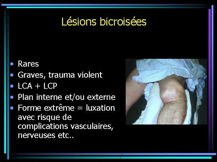 Lésions bicroisées • • • Rares Graves, trauma violent LCA + LCP Plan interne