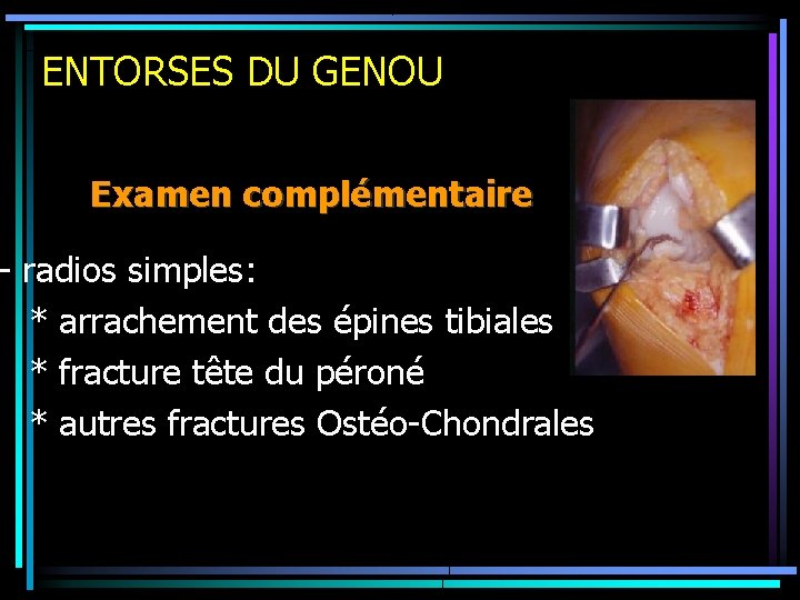 ENTORSES DU GENOU Examen complémentaire - radios simples: * arrachement des épines tibiales *