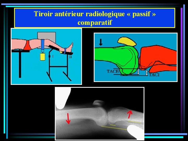 Tiroir antérieur radiologique « passif » comparatif 