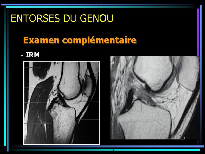 ENTORSES DU GENOU Examen complémentaire - IRM 