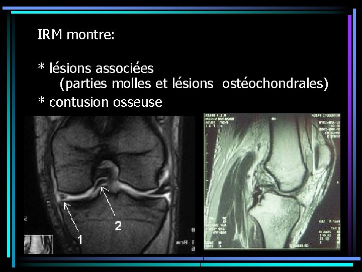 IRM montre: * lésions associées (parties molles et lésions ostéochondrales) * contusion osseuse 