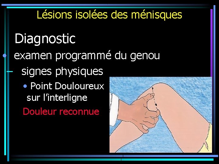 Lésions isolées des ménisques Diagnostic • examen programmé du genou – signes physiques •