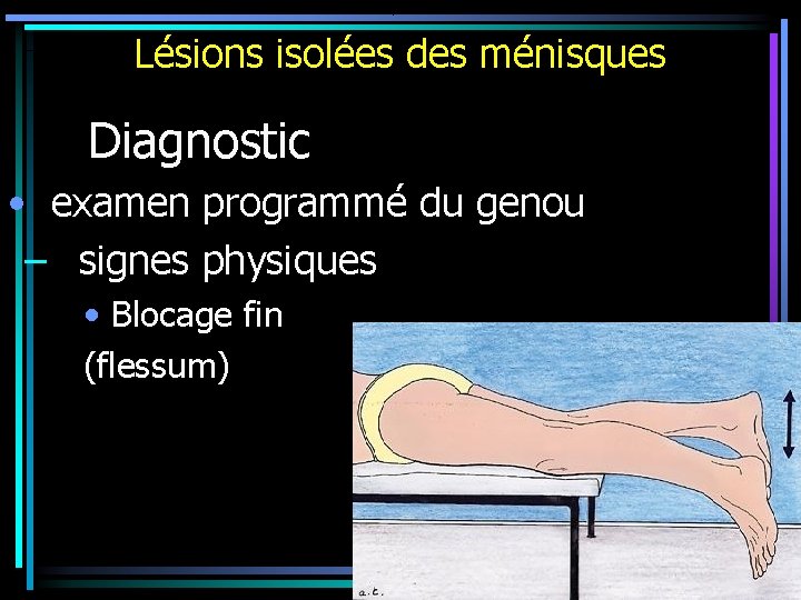 Lésions isolées des ménisques Diagnostic • examen programmé du genou – signes physiques •