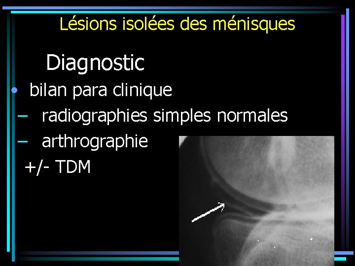 Lésions isolées des ménisques Diagnostic • bilan para clinique – radiographies simples normales –