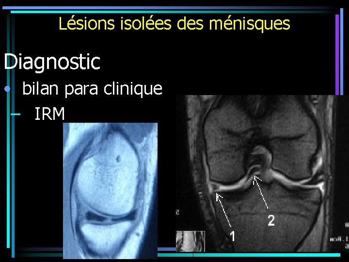 Lésions isolées des ménisques Diagnostic • bilan para clinique – IRM 