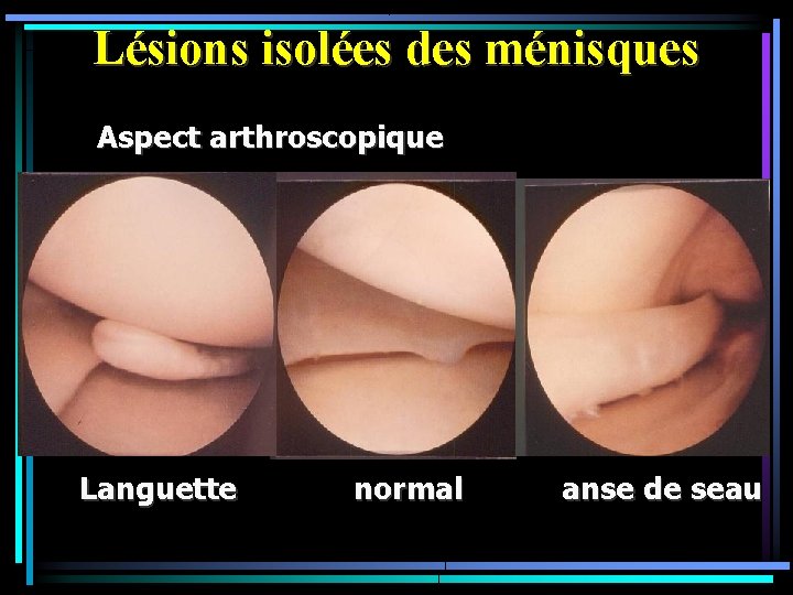 Lésions isolées des ménisques Aspect arthroscopique Languette normal anse de seau 