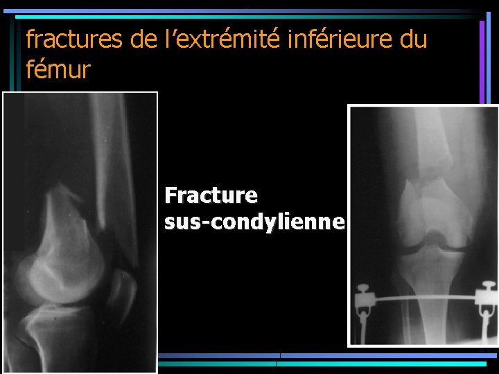 fractures de l’extrémité inférieure du fémur Fracture sus-condylienne 