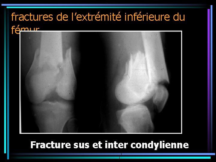 fractures de l’extrémité inférieure du fémur Fracture sus et inter condylienne 