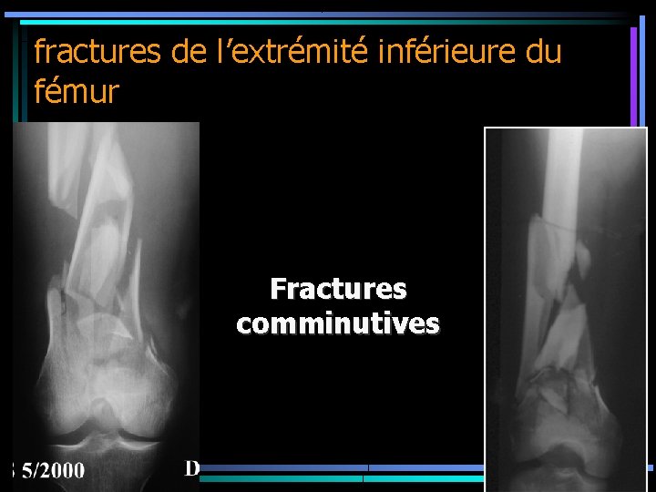 fractures de l’extrémité inférieure du fémur Fractures comminutives 