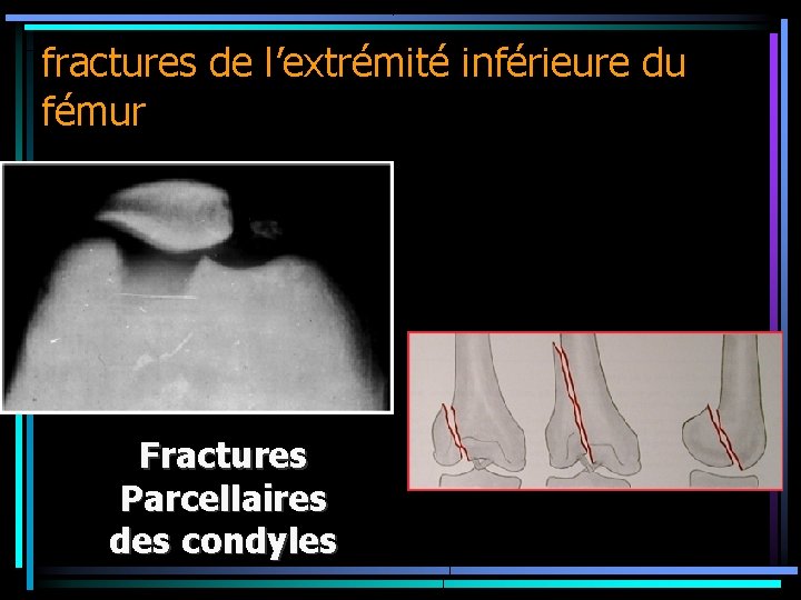 fractures de l’extrémité inférieure du fémur Fractures Parcellaires des condyles 