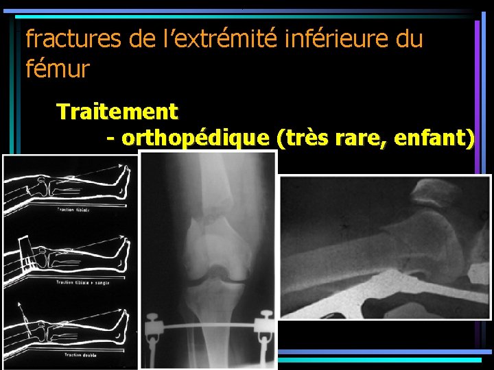 fractures de l’extrémité inférieure du fémur Traitement - orthopédique (très rare, enfant) 