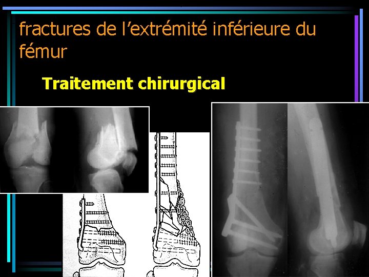 fractures de l’extrémité inférieure du fémur Traitement chirurgical 