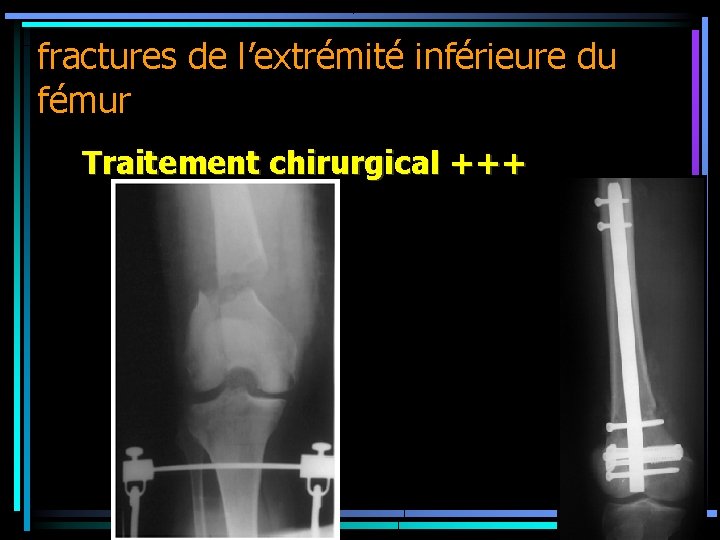 fractures de l’extrémité inférieure du fémur Traitement chirurgical +++ 