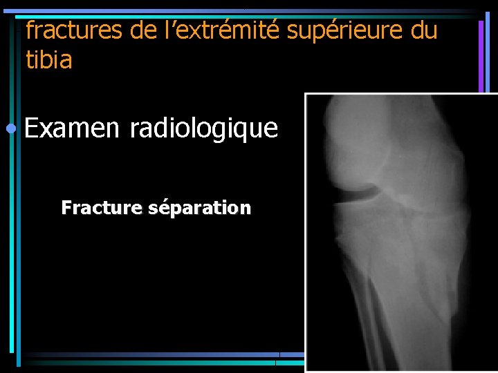 fractures de l’extrémité supérieure du tibia • Examen radiologique Fracture séparation 