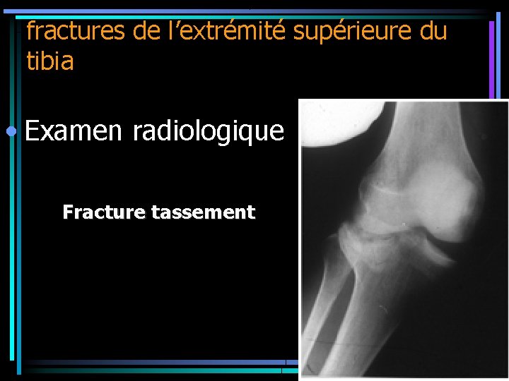 fractures de l’extrémité supérieure du tibia • Examen radiologique Fracture tassement 