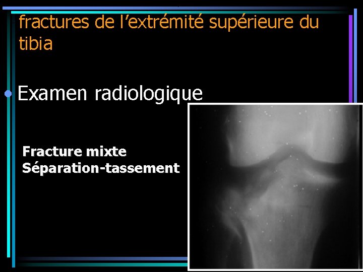 fractures de l’extrémité supérieure du tibia • Examen radiologique Fracture mixte Séparation-tassement 